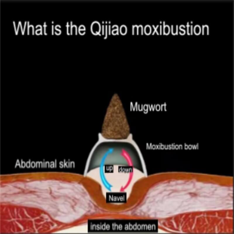 Qi Jiao Moxibustion Gift Box Set | Traditional Moxibustion Kit